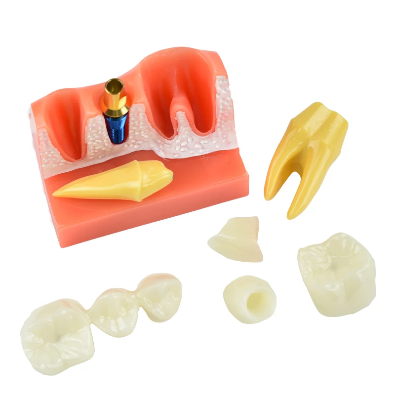 Dantų Mokymo Modelis 4 Kartus Dantų Implantas Analizė Karūna Tiltas Nuimamas Modelis Odontologija, Medicinos Mokslo, Mokymo Studijų . ' - ' . 1