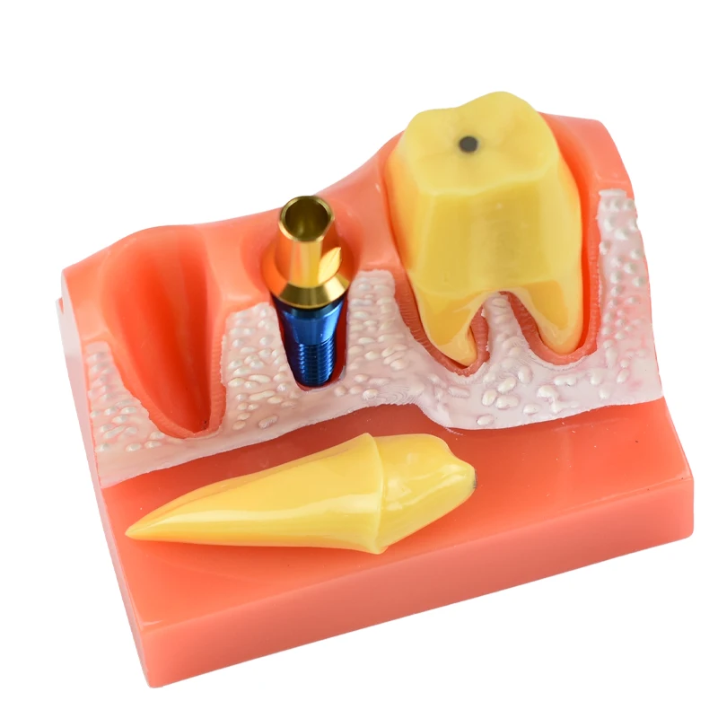 Dantų Mokymo Modelis 4 Kartus Dantų Implantas Analizė Karūna Tiltas Nuimamas Modelis Odontologija, Medicinos Mokslo, Mokymo Studijų . ' - ' . 2