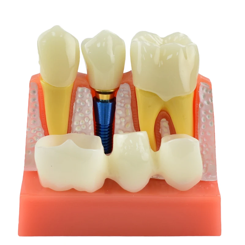 Dantų Mokymo Modelis 4 Kartus Dantų Implantas Analizė Karūna Tiltas Nuimamas Modelis Odontologija, Medicinos Mokslo, Mokymo Studijų . ' - ' . 3