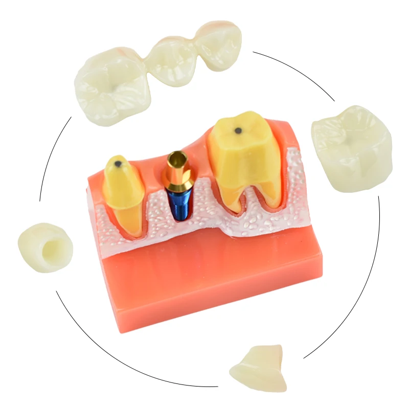 Dantų Mokymo Modelis 4 Kartus Dantų Implantas Analizė Karūna Tiltas Nuimamas Modelis Odontologija, Medicinos Mokslo, Mokymo Studijų . ' - ' . 5