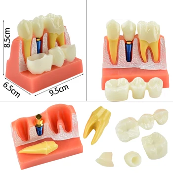 Dantų Mokymo Modelis 4 Kartus Dantų Implantas Analizė Karūna Tiltas Nuimamas Modelis Odontologija, Medicinos Mokslo, Mokymo Studijų